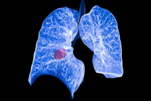 Tumor localizado en los pulmones. Fotografía: ATS-Archivo