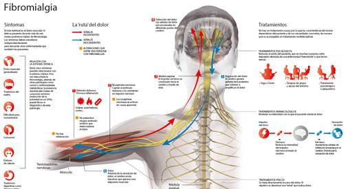 dolor, cuerpo, fibromialgia, enfermedad, síntomas, tratamiento