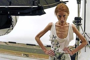 Modelo española que sufrió anorexia