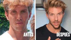 El antes y después de Tadeo después de procedimientos estéticos realizados
